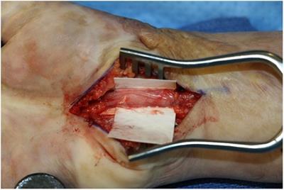 Outcomes following use of VersaWrap nerve protector in treatment of patients with recurrent compressive neuropathies